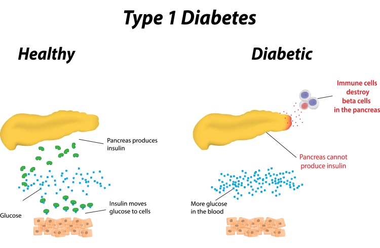 Type 1 Diabetes