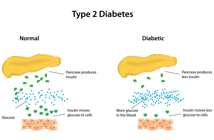 Type 1 Diabetes