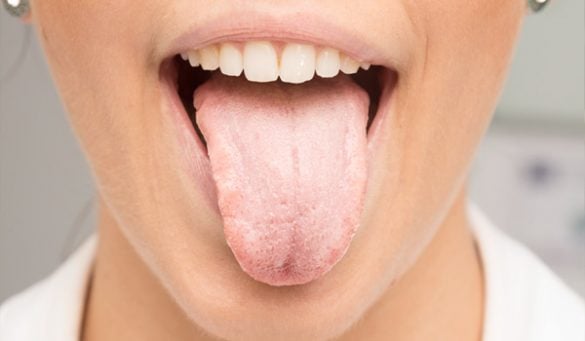 Ways To Get Rid of White Tongue