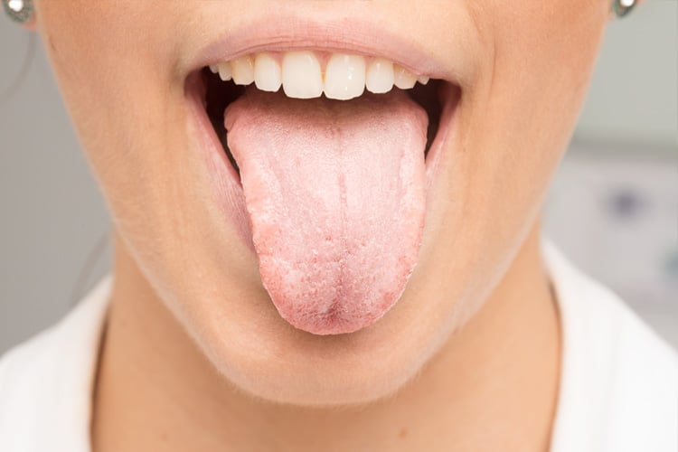 Ways To Get Rid of White Tongue