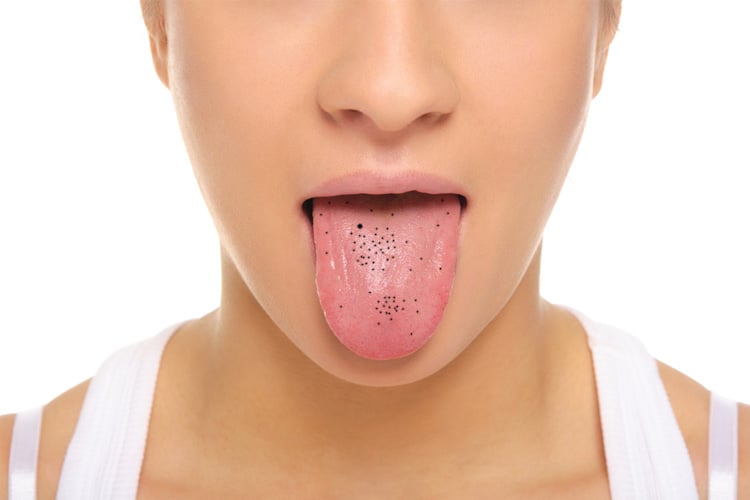 Black Spots On Tongue