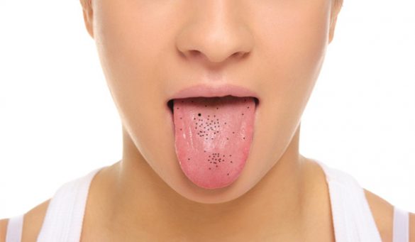 Black Spots On Tongue