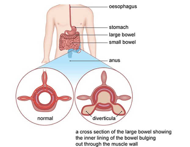 Diverticula