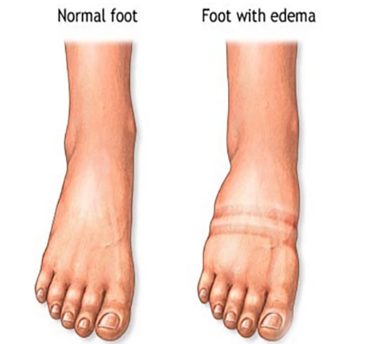 Fluid Retention Before After