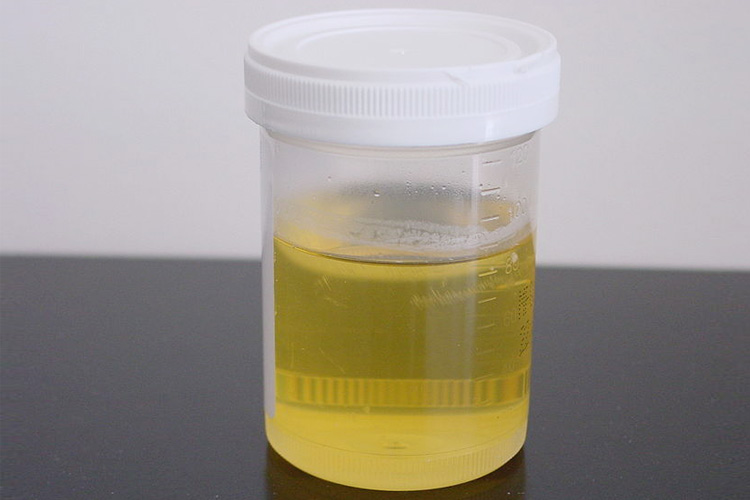 Foamy Urine Causes