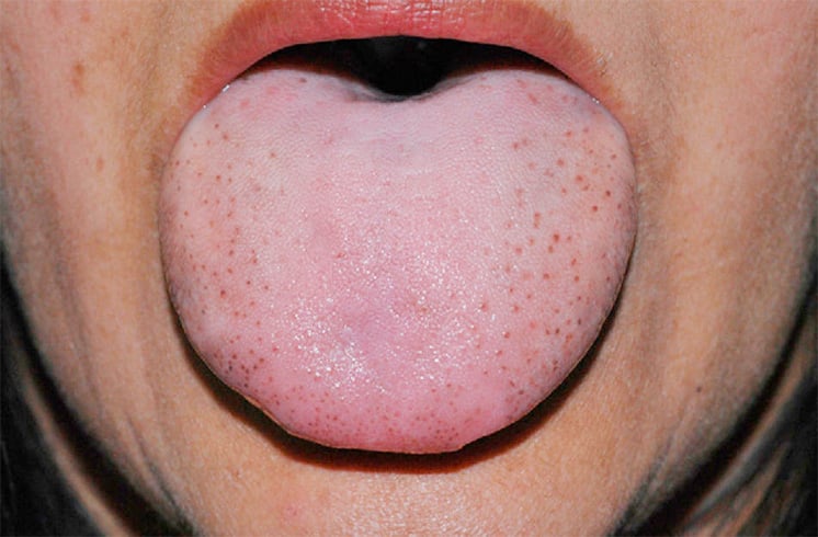 Tongue Fungal Infections