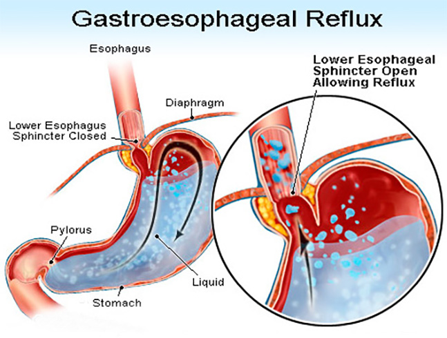 Gastro Esophagus Reflux