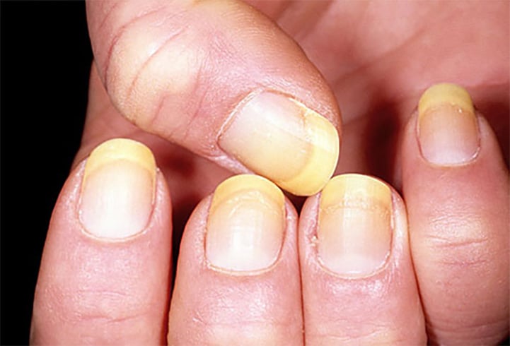 Get Rid of Yellow Nails