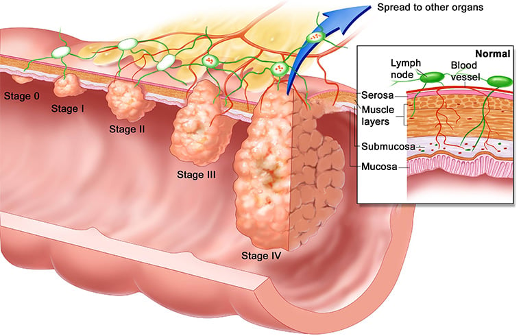 Outer Oesophageal Growths