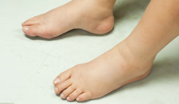 Remedies for Water Retention