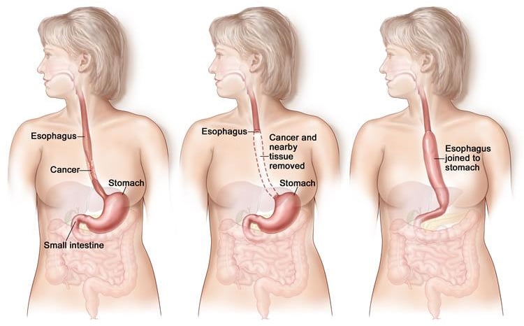 Tumors in the oesophagus