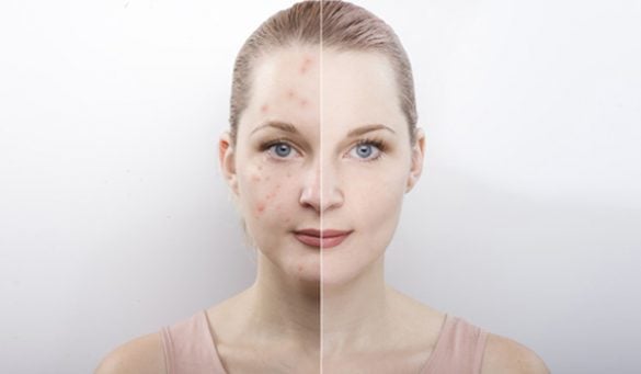 Acne Natural Treatment
