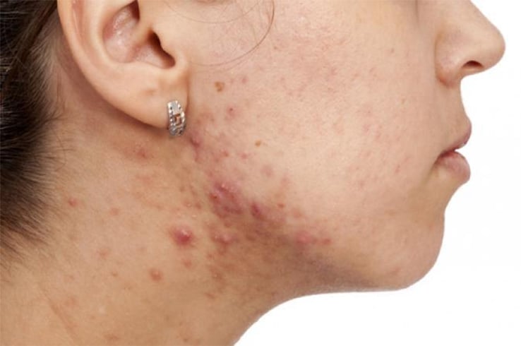 Characteristics of Hormonal Acne