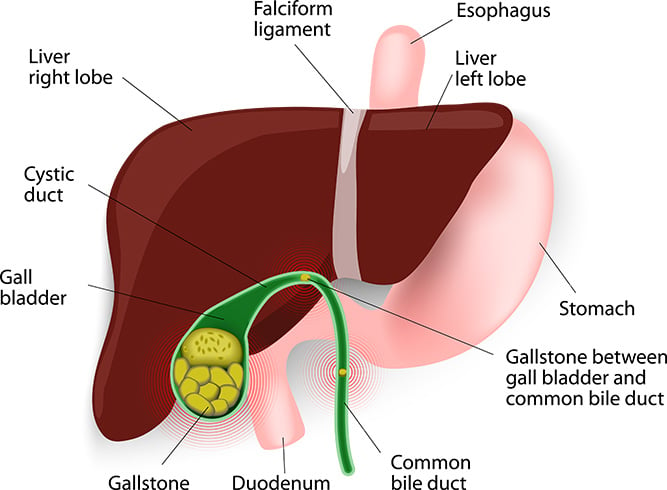 Gallstones