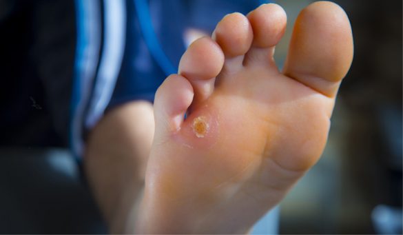 Get Rid of Corns On Feet