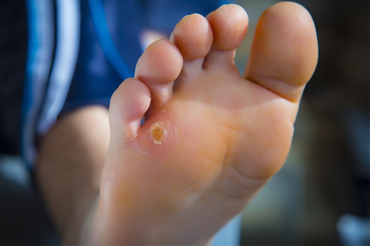 Home Remedies To Get Rid Of Corns On Feet