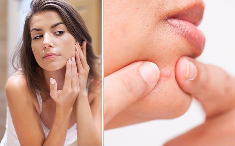 How do you know if your acne is hormonal