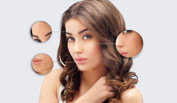 Remedies for Chicken Pox Scar Removal