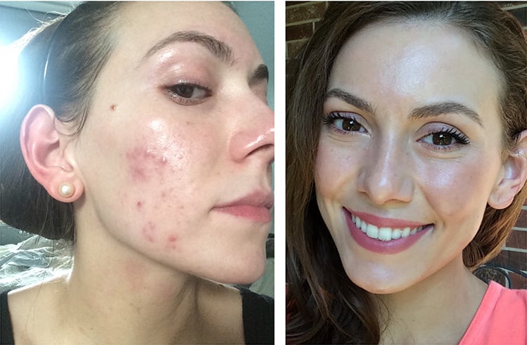 Hormonal Acne Natural Treatment Along With Causes Symptoms And Diet Plan 