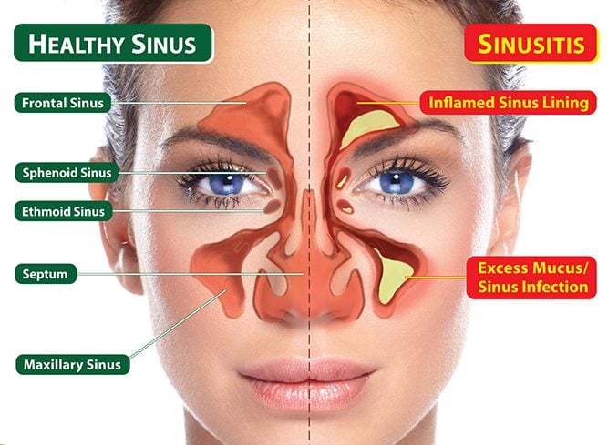 What is Sinusitis