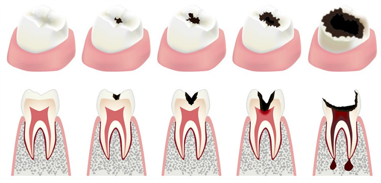 Cavities Causes