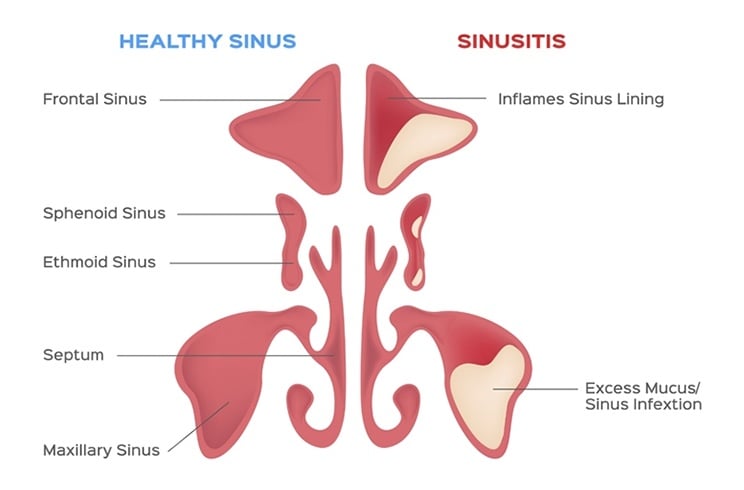 Sinusitis