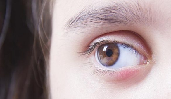 Causes Of Swollen Eyelids