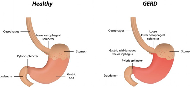 Gastroesophageal Reflux Disease