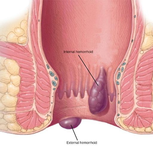 Hemorrhoids