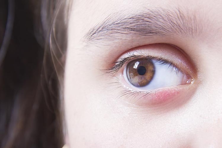 Swollen Eyelids Causes