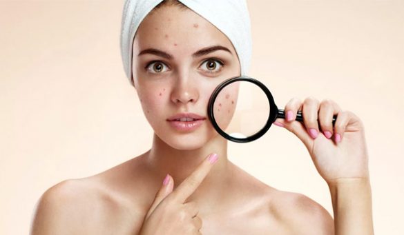 Best Benzoyl Peroxide Acne Treatments