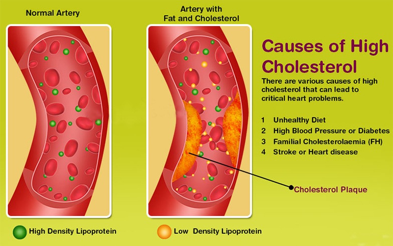 Causes High Cholesterol