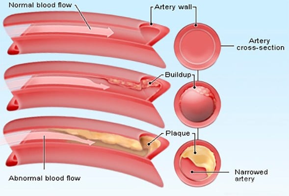 How To Lower Your Cholesterol