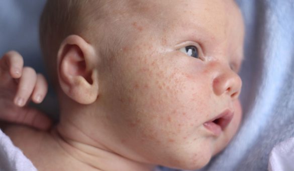 Baby Acne On Face