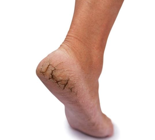 Common Causes Of Dry Cracked Feet