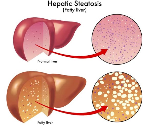 Fatty Liver Disease