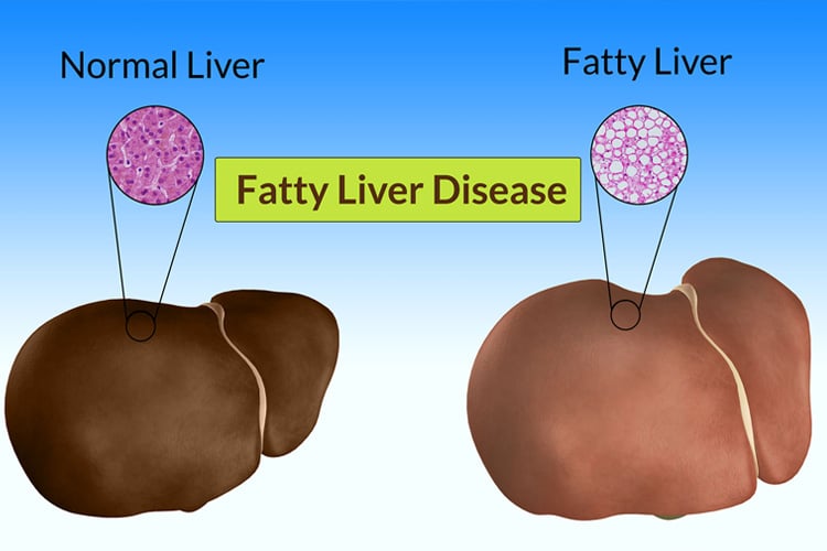 Fatty Liver