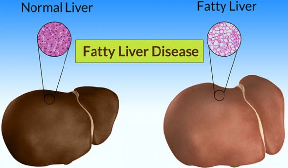 Liver Disease