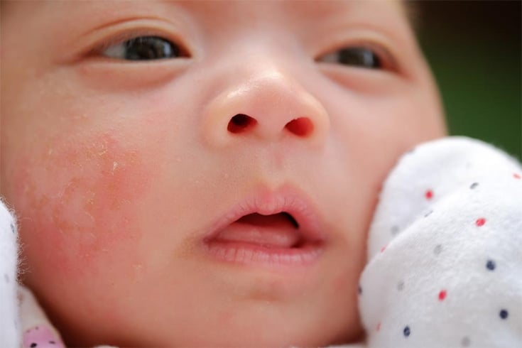 Neonatal Acne