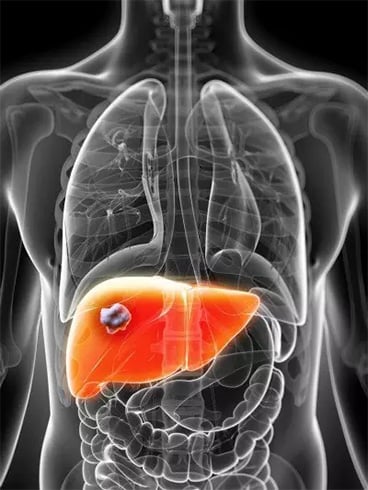 Signs Of Getting Fatty Liver