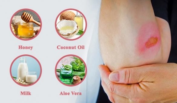 Home Remedies For Burn