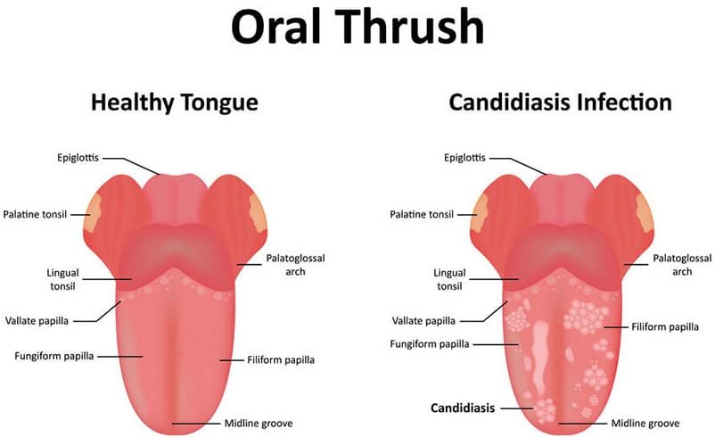 Candidiasis Infection