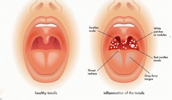 White Spots On The Throat