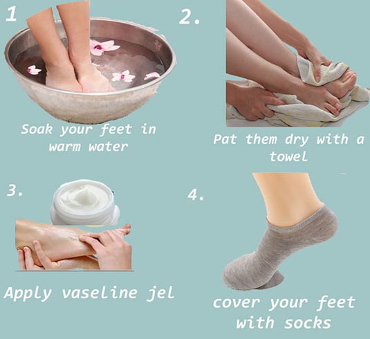 cracked heels treatment