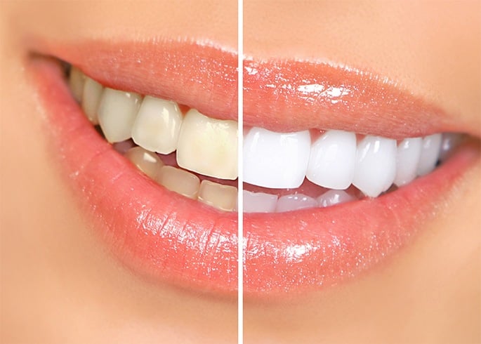 Gums Turning White Around Teeth