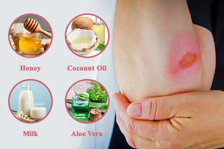 Home Remedies For Burn
