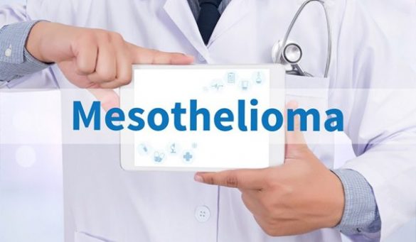Mesothelioma Rare Cancer With No Cure