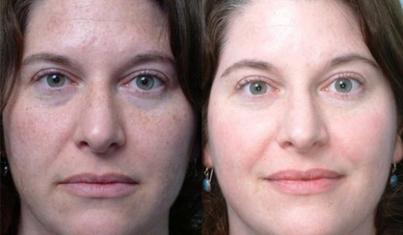 Say Bye To Your Dark Spots