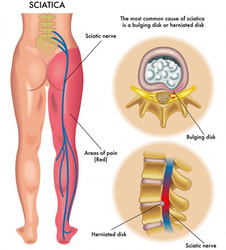 Sciatic Nerve Pain