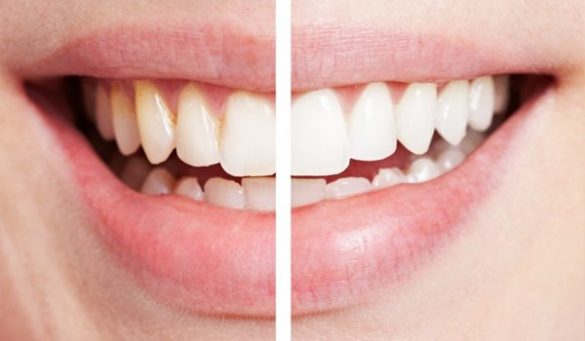 Causes Of White Gums Around Teeth